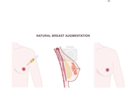 Illustration for Natural breast augmentation with fat transferred into the breast from other body parts. Fat tissue injection illustration with before and after effect on nude body shape.. Vector illustration - Royalty Free Image