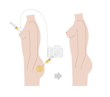 Illustration for Natural breast augmentation with fat transferred into the breast from other body parts. Fat tissue injection illustration with before and after effect on naked body side view.. Vector illustration - Royalty Free Image