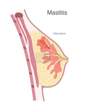 Illustration for Side view of breast internal structure with mammary gland lobe and fat tissue inflammation shown with reddish color. Human medical anatomy illustration. Vector illustration - Royalty Free Image