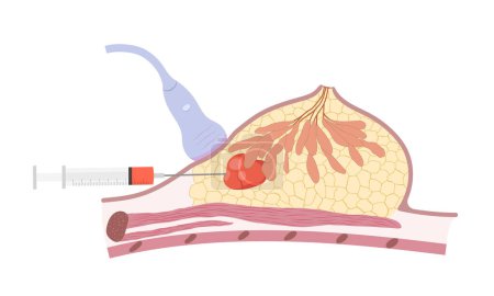 Illustration for Breast cancer diagnostic biopsy for the specimen. Side view cross section of human female breast with mammary gland and unknown cyst in fat tissue. Vector illustration - Royalty Free Image