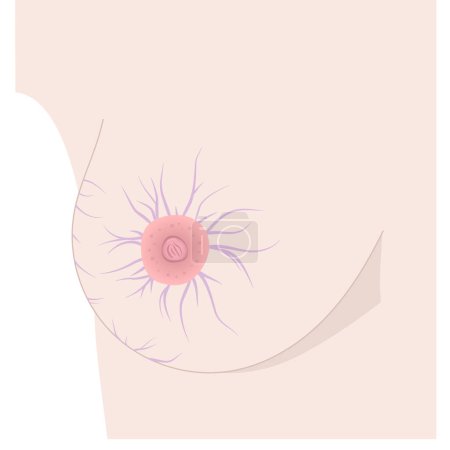 Ilustración de Marcas de estiramiento en el vector mamario. Pecho de mujer desnuda con estrías que se muestran alrededor del pezón y en los lados. Ilustración vectorial - Imagen libre de derechos