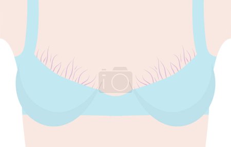 Illustration for Stretch marks on breast vector. Woman breast in bra with striae shown on skin. Vector illustration - Royalty Free Image