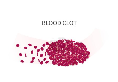 Illustration for Erythrocytes and thrombus structure with platelets and fibrin at the background of blood vessel illustration for the main page of educational or medical material. Vector illustration - Royalty Free Image