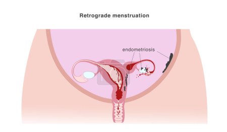 Ilustración de Malformación congénita del útero que aísla parte del órgano y casos menstruación retrógrada como una de las posibles causas de endometriosis. Ilustración vectorial - Imagen libre de derechos