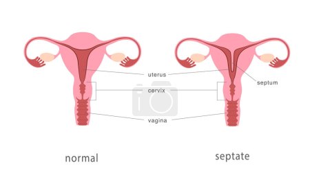 Ilustración de Sepa y estructura normal del útero humano. Tabique uterino como malformación uterina congénita. Carta de anatomía. Ilustración vectorial - Imagen libre de derechos