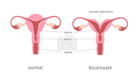 Ilustración de Estructura uterina humana bicornuada y normal. Tabique uterino profundo como malformación uterina congénita. Carta de anatomía. Ilustración vectorial - Imagen libre de derechos