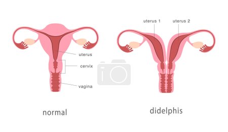 Ilustración de Didelphis y la estructura normal del útero humano. Tabique uterino profundo como malformación uterina congénita. Carta de anatomía. Ilustración vectorial - Imagen libre de derechos