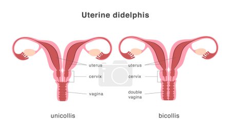 Didelphis human uterus structure of unicollis and bicollis types. Uterine deep septum as a congenital uterine malformation. Anatomy chart. Vector illustration
