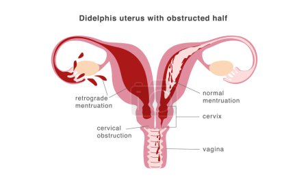 Illustration for Congenital malformation of uterus isolating part of organ and causing retrograde menstruation as possible reason of endometriosis. Vector illustration - Royalty Free Image