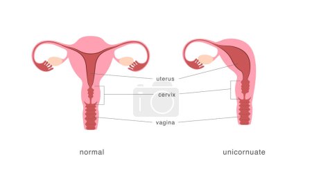 Illustration for Unicornuate and normal healthy uterus comparison chart. Congenital malformation of female reproductive system. Vector illustration - Royalty Free Image