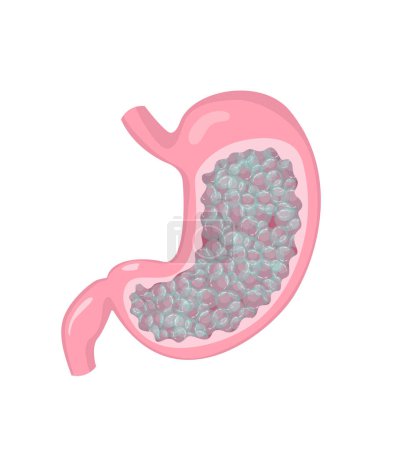 Illustration for Stomach with gas and bloating feeling. Human internal organ disorder pathology. Vector illustration - Royalty Free Image
