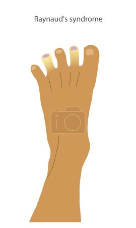 Illustration for A foot with Raynauds syndrome symptoms on tips of the toes. Peripheral cyanosis shown as white and discoloured toes. . Vector illustration - Royalty Free Image