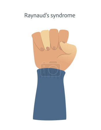 Illustration for A hand with Raynauds syndrome symptoms on fingertips. Peripheral cyanosis shown as white and discoloured fingers. . Vector illustration - Royalty Free Image