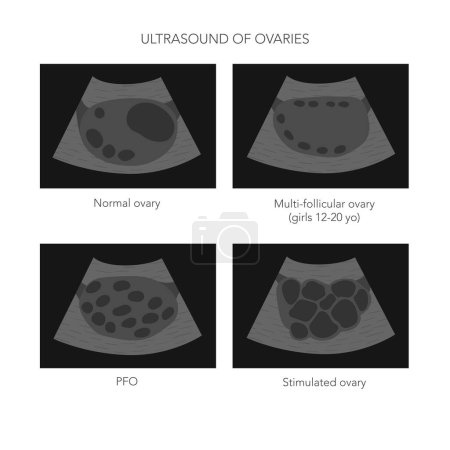 Ilustración vectorial médica de la ecografía ovárica con imágenes ováricas normales, poliquísticas y estimuladas. Ilustración vectorial