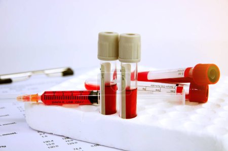 Hematology blood analysis report with lavender color blood sample collection tubes and syringe.(blue tone)