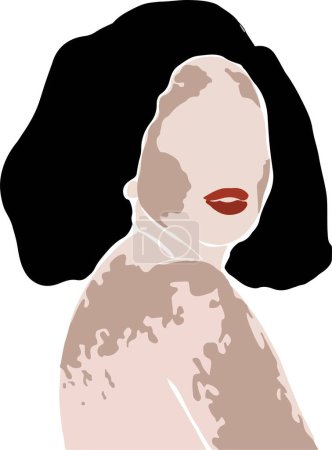 Ilustración de Ilustración vectorial de una hermosa mujer vitiligo en medio turno, piel única, concepto de belleza natural - Imagen libre de derechos