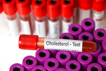Téléchargez les photos : Test de cholestérol pour rechercher des anomalies du sang, échantillon de sang à analyser en laboratoire, sang dans une éprouvette - en image libre de droit