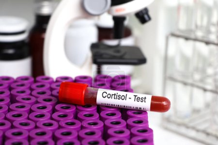 Cortisol test to look for abnormalities from blood,  blood sample to analyze in the laboratory, blood in test tube