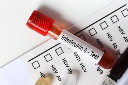 Interleukin-6-Test auf Auffälligkeiten im Blut, Blutprobe zur Analyse im Labor, Blut im Reagenzglas