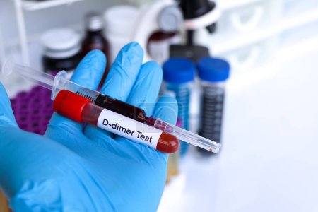 D-Dimer-Test auf Auffälligkeiten im Blut, Blutprobe zur Analyse im Labor, Blut im Reagenzglas