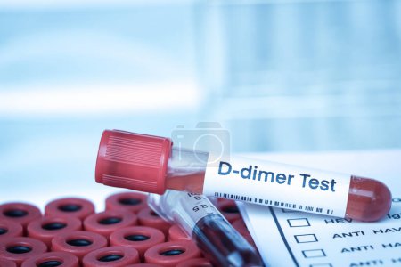 D-dimer test to look for abnormalities from blood,  blood sample to analyze in the laboratory, blood in test tube