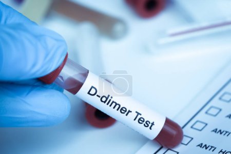 Prueba de dímero D para buscar anomalías en la sangre, muestra de sangre para analizar en el laboratorio, sangre en la sonda de ensayo