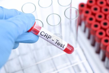 Téléchargez les photos : Test CRP pour rechercher des anomalies du sang, échantillon de sang à analyser en laboratoire, sang dans une éprouvette - en image libre de droit