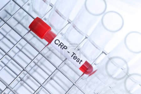 CRP-Test auf Auffälligkeiten im Blut, Blutprobe zur Analyse im Labor, Blut im Reagenzglas