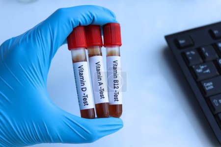Photo for Blood samples for testing vitamin in the laboratory, blood sample in test tube - Royalty Free Image