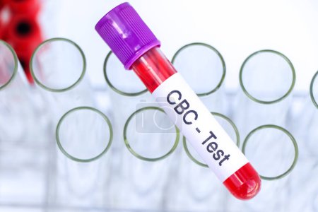Test CBC pour rechercher des anomalies du sang, échantillon de sang à analyser en laboratoire, sang dans une éprouvette
