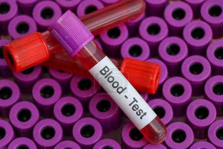 Téléchargez les photos : Test sanguin pour rechercher des anomalies du sang, prélèvement sanguin à analyser en laboratoire, sang dans une éprouvette - en image libre de droit