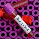 Blood test to look for abnormalities from blood,  blood sample to analyze in the laboratory, blood in test tube