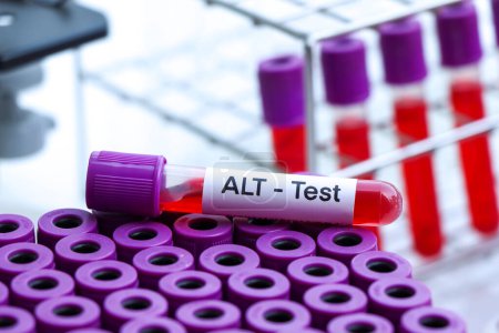 Téléchargez les photos : Test ALAT pour rechercher des anomalies du sang, prélèvement sanguin à analyser en laboratoire, sang dans une éprouvette - en image libre de droit