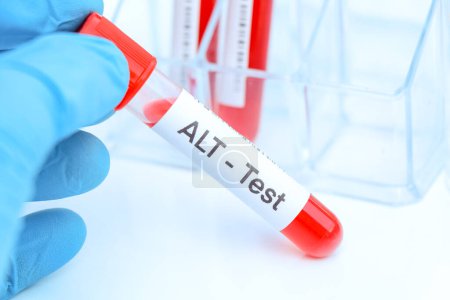 ALT test to look for abnormalities from blood,  blood sample to analyze in the laboratory, blood in test tube