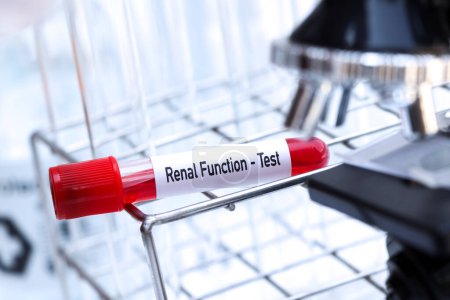 Photo for Renal function test to look for abnormalities from blood,  blood sample to analyze in the laboratory, blood in test tube - Royalty Free Image