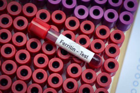 Photo for Ferritin test to look for abnormalities from blood,  blood sample to analyze in the laboratory, blood in test tube - Royalty Free Image