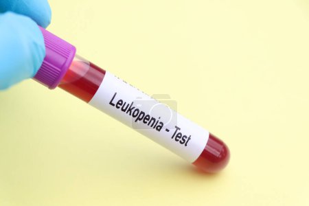 Photo for Leukopenia test, blood sample to analyze in the laboratory, blood in test tube - Royalty Free Image
