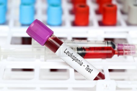 Foto de Prueba de leucopenia, muestra de sangre para analizar en el laboratorio, sangre en el tubo de ensayo - Imagen libre de derechos