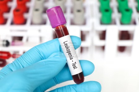 Foto de Prueba de leucopenia, muestra de sangre para analizar en el laboratorio, sangre en el tubo de ensayo - Imagen libre de derechos