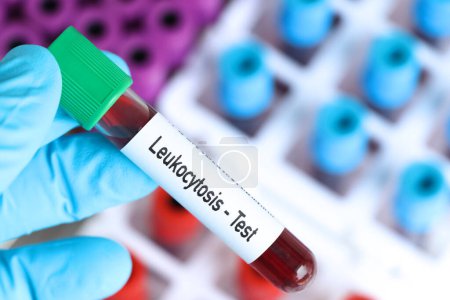 Foto de Prueba de leucocitosis, muestra de sangre para analizar en el laboratorio, sangre en el tubo de ensayo - Imagen libre de derechos