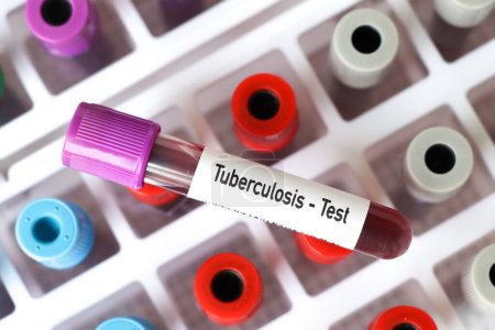 Test de tuberculose, échantillon de sang à analyser en laboratoire, sang dans une éprouvette
