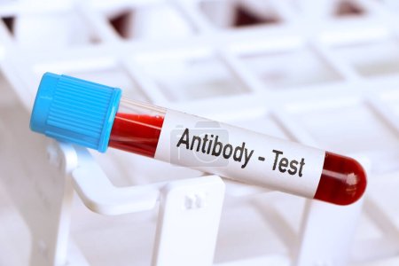 Antibody test, blood sample to analyze in the laboratory, blood in test tube
