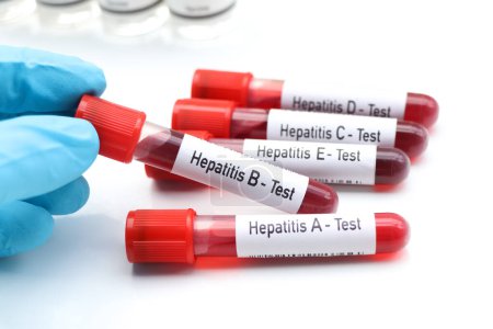 Hepatitis test to look for abnormalities from blood, scientific experiment