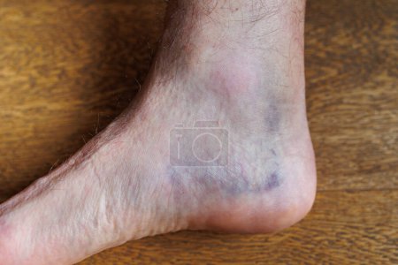 Große Prellung in der Ferse des Fußes nach einer Dehnungsverletzung.