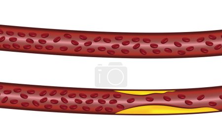 Illustration for Veins blood vessels normal flow and blocked veins blood vessels flow - Royalty Free Image
