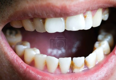Photo for Tooth's a man smoking bad. Man smokes a cigarettes have tooth decay and calculus on teeth, So we should be care dental with the hygiene - Royalty Free Image
