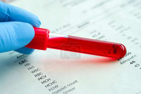 Complete blood samples and blood test results . Health and medical concepts