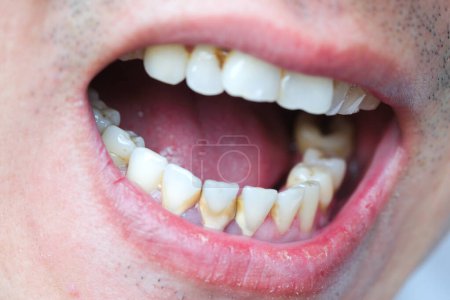 Photo for Tooth's a man smoking bad. Man smokes a cigarettes have tooth decay and calculus on teeth, So we should be care dental with the hygiene.soft focus - Royalty Free Image