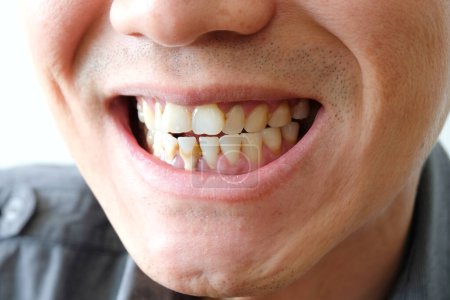 Zahn raucht schlecht. Der Mensch raucht eine Zigarette haben Karies und Zahnstein auf den Zähnen, so sollten wir zahnärztliche Versorgung mit der hygiene.soft Fokus