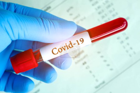 Muestras de sangre y resultados de los análisis de sangre de la enfermedad Coronavirus Covid 19.New epidemic prevention conce